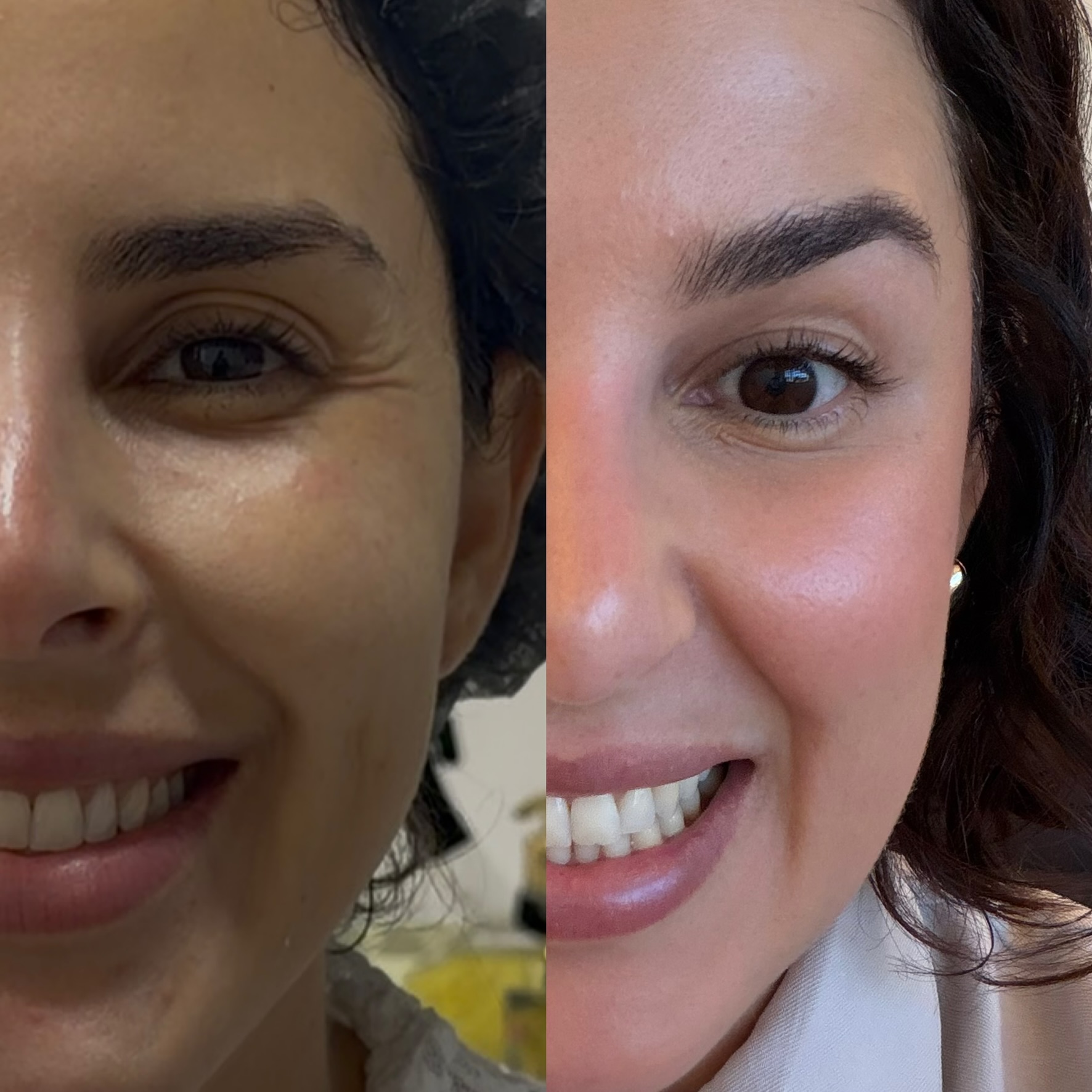 Botox before and after comparison