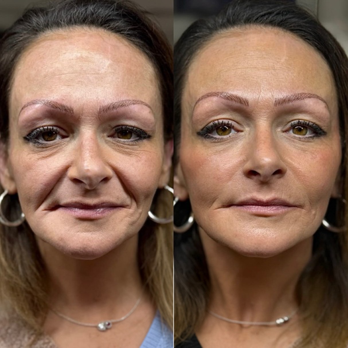 Facial lift before and after comparison