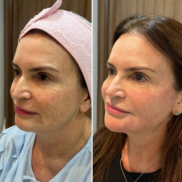 Daya Medspa client photos: A smoother, firmer face